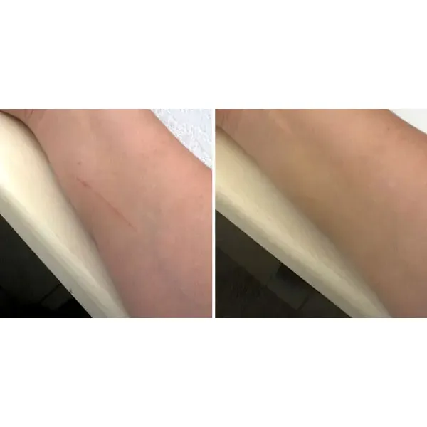 EraseZit Pencil - Acne & Blemish Concealer