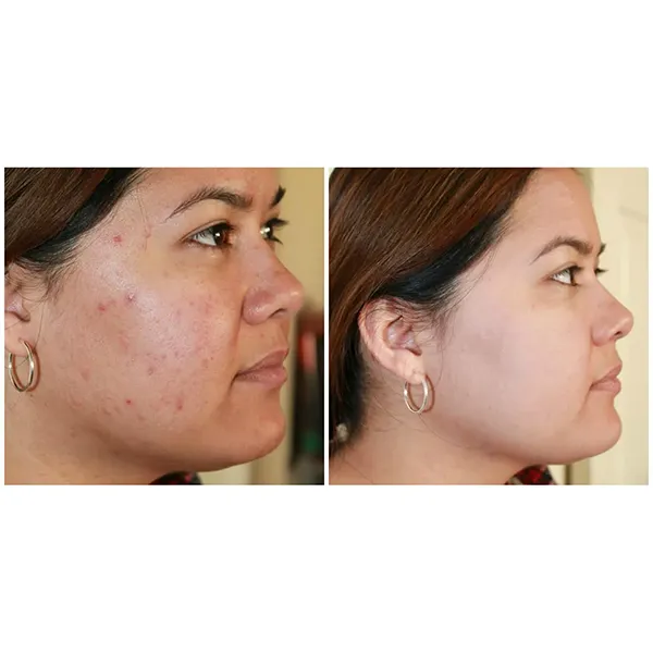 EraseZit Pencil - Acne & Blemish Concealer