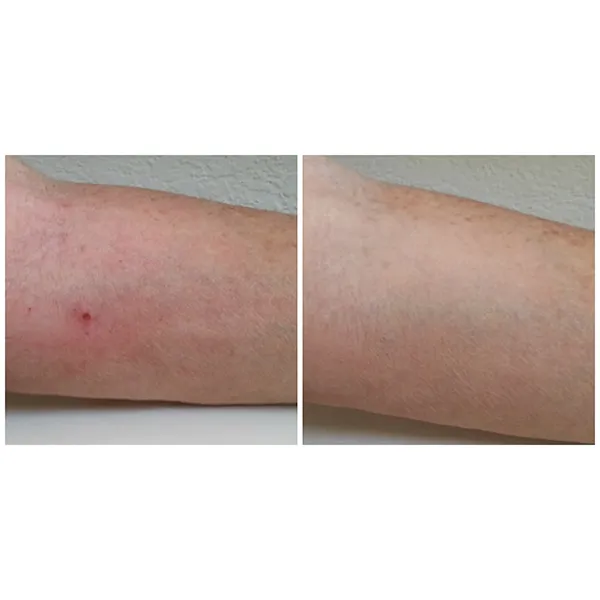 EraseZit Pencil - Acne & Blemish Concealer