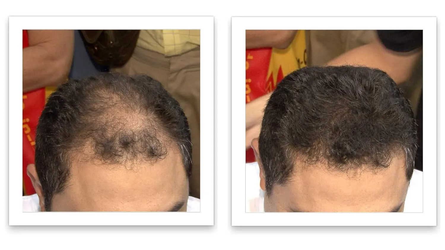 Hair Loss Concealer, 90-Day Supply, Dark Brown