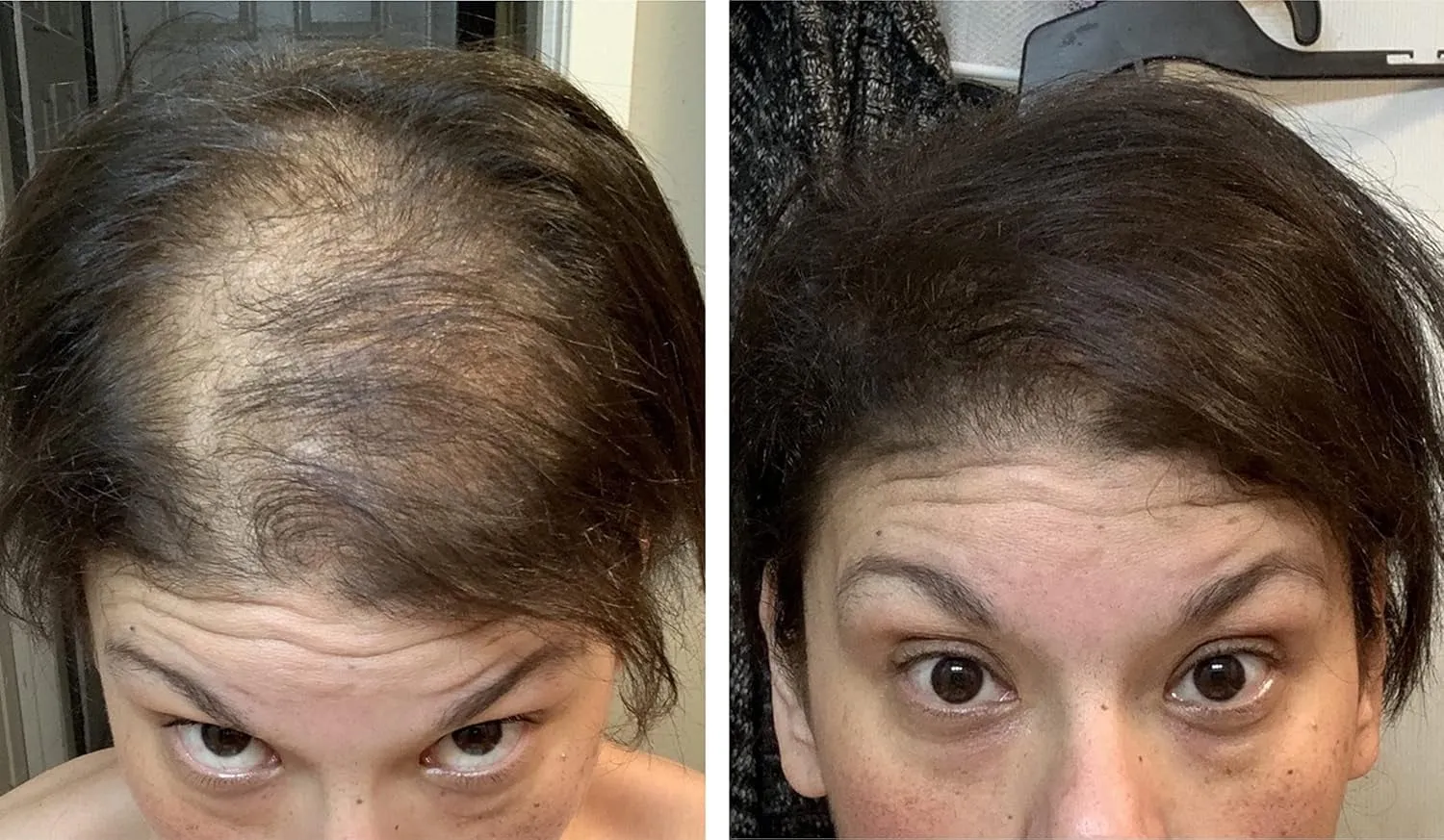Hair Loss Concealer, 90-Day Supply, Dark Brown